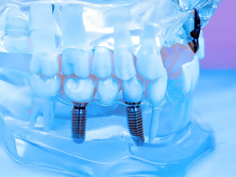 Cosmetic Dentistry Miami, Miami Teeth Whitening, Dental Veneers Miami FL, Best Cosmetic Dentist Miami, True Dentistry Plus Services, Dental Implants Miami, Permanent Tooth Replacement Miami, True Dentistry Plus Dental Implants, Best Implant Dentist in Miami, Miami Dental Implant Services, Dentures Miami, Custom Dentures Miami FL, Full Dentures Miami, Partial Dentures Miami, True Dentistry Plus Dentures, Gum Contouring Miami, Miami Gum Reshaping, Cosmetic Gum Surgery Miami FL, True Dentistry Plus Gum Contouring, Smile Enhancement Miami, Porcelain Crowns Miami, Durable Dental Crowns Miami FL, True Dentistry Plus Crowns, Cosmetic Dental Crowns Miami, Natural-Looking Crowns Miami, Smile Makeover Miami, True Dentistry Plus Smile Enhancement, Miami Smile Design, Full Smile Restoration Miami, Professional Teeth Bleaching Miami, True Dentistry Plus Whitening Services, Miami Cosmetic Teeth Whitening, Best Teeth Whitening Miami FL, Porcelain Veneers Miami FL, True Dentistry Plus Veneers, Cosmetic Veneers Miami, Best Veneers Dentist in Miami, Emergency Dentist Miami, 24/7 Dental Care Miami FL, Urgent Dental Care Miami, True Dentistry Plus Emergency Services, Miami Emergency Dental Services, Miami Dentist, Dental Care Miami FL, Family Dentistry Miami, Dental Health Blog Miami, True Dentistry Plus Blog, Miami Dental Care Tips, Dental News Miami FL, Oral Health Insights Miami, Contact True Dentistry Plus, Miami Dentist Contact, Schedule Dental Appointment Miami, Dental Office Location Miami, True Dentistry Plus Phone Number, Dental Deals Miami, True Dentistry Plus Specials, Miami Dental Offers, Teeth Whitening Discounts Miami, Invisalign Promotion Miami, Oral Surgery Miami, Wisdom Tooth Extraction Miami FL, True Dentistry Plus Oral Surgeons, Miami Oral Surgery Clinic, Tooth Extractions Miami, Bone Grafting Miami FL, Dental Surgery Miami, True Dentistry Plus Extractions, Miami Bone Graft Procedures, LANAP Miami, Laser Gum Therapy Miami FL, Minimally Invasive Gum Treatment Miami, True Dentistry Plus LANAP, Gum Disease Treatment Miami, Sinus Lift Surgery Miami, Dental Implant Preparation Miami, True Dentistry Plus Sinus Lift, Sinus Augmentation Miami, Wisdom Tooth Extractions Miami, Remove Wisdom Teeth Miami FL, Oral Surgery for Wisdom Teeth Miami, Miami Wisdom Teeth Removal, Orthodontics Miami, Braces Miami FL, Invisalign Miami, True Dentistry Plus Orthodontics, Teeth Straightening Miami, Clear Aligners Miami FL, True Dentistry Plus Invisalign, Invisalign Dentist Miami, Invisible Braces Miami, Preventive Dentistry Miami, Dental Cleanings Miami FL, Oral Exams Miami, True Dentistry Plus Preventive Care, Miami Dental Checkups, Comprehensive Dental Exams Miami, Full Oral Exam Miami FL, Dental Checkup Miami, True Dentistry Plus Exams, Dental Hygiene Miami, Teeth Cleaning Miami FL, Oral Hygiene Services Miami, True Dentistry Plus Dental Cleanings, Preventive Dental Care Miami, Nightguards Miami, Custom Mouthguards Miami FL, Teeth Grinding Protection Miami, Bruxism Treatment Miami, True Dentistry Plus Nightguards, Oral Cancer Screening Miami, Early Detection Oral Cancer Miami FL, Oral Health Screening Miami, True Dentistry Plus Screenings, Periodontics Miami, Deep Cleaning Dentist Miami, True Dentistry Plus Periodontics, Scaling and Root Planing Miami, Sleep Apnea Therapy Miami, Snoring Treatment Miami FL, Sleep Apnea Dentist Miami, Oral Appliance Therapy Miami, True Dentistry Plus Sleep Solutions, TMJ Treatment Miami, TMD Therapy Miami FL, Jaw Pain Relief Miami, True Dentistry Plus TMJ Specialist, TMJ Dentist Miami, Restorative Dentistry Miami, Dental Crowns and Bridges Miami FL, Tooth Repair Miami, True Dentistry Plus Restorations, Dental Bridges Miami, Replace Missing Teeth Miami FL, Tooth Bridge Miami, True Dentistry Plus Dental Bridges, Fixed Dental Bridge Miami, Dental Fillings Miami, Cavity Treatment Miami FL, Tooth Fillings Miami, Composite Fillings Miami, True Dentistry Plus Fillings, Smile Restoration Miami FL, Complete Dental Makeover Miami, True Dentistry Plus Reconstruction, Rebuild Smile Miami, Full-Arch Dental Implants Miami, All-on-4 Implants Miami FL, Full Mouth Implants Miami, True Dentistry Plus Implants, Root Canal Miami, Endodontic Treatment Miami FL, Tooth Pain Relief Miami, True Dentistry Plus Root Canal, Save Infected Tooth Miami