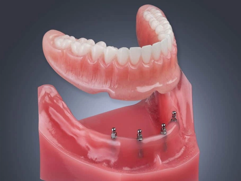 Cosmetic Dentistry Miami, Miami Teeth Whitening, Dental Veneers Miami FL, Best Cosmetic Dentist Miami, True Dentistry Plus Services, Dental Implants Miami, Permanent Tooth Replacement Miami, True Dentistry Plus Dental Implants, Best Implant Dentist in Miami, Miami Dental Implant Services, Dentures Miami, Custom Dentures Miami FL, Full Dentures Miami, Partial Dentures Miami, True Dentistry Plus Dentures, Gum Contouring Miami, Miami Gum Reshaping, Cosmetic Gum Surgery Miami FL, True Dentistry Plus Gum Contouring, Smile Enhancement Miami, Porcelain Crowns Miami, Durable Dental Crowns Miami FL, True Dentistry Plus Crowns, Cosmetic Dental Crowns Miami, Natural-Looking Crowns Miami, Smile Makeover Miami, True Dentistry Plus Smile Enhancement, Miami Smile Design, Full Smile Restoration Miami, Professional Teeth Bleaching Miami, True Dentistry Plus Whitening Services, Miami Cosmetic Teeth Whitening, Best Teeth Whitening Miami FL, Porcelain Veneers Miami FL, True Dentistry Plus Veneers, Cosmetic Veneers Miami, Best Veneers Dentist in Miami, Emergency Dentist Miami, 24/7 Dental Care Miami FL, Urgent Dental Care Miami, True Dentistry Plus Emergency Services, Miami Emergency Dental Services, Miami Dentist, Dental Care Miami FL, Family Dentistry Miami, Dental Health Blog Miami, True Dentistry Plus Blog, Miami Dental Care Tips, Dental News Miami FL, Oral Health Insights Miami, Contact True Dentistry Plus, Miami Dentist Contact, Schedule Dental Appointment Miami, Dental Office Location Miami, True Dentistry Plus Phone Number, Dental Deals Miami, True Dentistry Plus Specials, Miami Dental Offers, Teeth Whitening Discounts Miami, Invisalign Promotion Miami, Oral Surgery Miami, Wisdom Tooth Extraction Miami FL, True Dentistry Plus Oral Surgeons, Miami Oral Surgery Clinic, Tooth Extractions Miami, Bone Grafting Miami FL, Dental Surgery Miami, True Dentistry Plus Extractions, Miami Bone Graft Procedures, LANAP Miami, Laser Gum Therapy Miami FL, Minimally Invasive Gum Treatment Miami, True Dentistry Plus LANAP, Gum Disease Treatment Miami, Sinus Lift Surgery Miami, Dental Implant Preparation Miami, True Dentistry Plus Sinus Lift, Sinus Augmentation Miami, Wisdom Tooth Extractions Miami, Remove Wisdom Teeth Miami FL, Oral Surgery for Wisdom Teeth Miami, Miami Wisdom Teeth Removal, Orthodontics Miami, Braces Miami FL, Invisalign Miami, True Dentistry Plus Orthodontics, Teeth Straightening Miami, Clear Aligners Miami FL, True Dentistry Plus Invisalign, Invisalign Dentist Miami, Invisible Braces Miami, Preventive Dentistry Miami, Dental Cleanings Miami FL, Oral Exams Miami, True Dentistry Plus Preventive Care, Miami Dental Checkups, Comprehensive Dental Exams Miami, Full Oral Exam Miami FL, Dental Checkup Miami, True Dentistry Plus Exams, Dental Hygiene Miami, Teeth Cleaning Miami FL, Oral Hygiene Services Miami, True Dentistry Plus Dental Cleanings, Preventive Dental Care Miami, Nightguards Miami, Custom Mouthguards Miami FL, Teeth Grinding Protection Miami, Bruxism Treatment Miami, True Dentistry Plus Nightguards, Oral Cancer Screening Miami, Early Detection Oral Cancer Miami FL, Oral Health Screening Miami, True Dentistry Plus Screenings, Periodontics Miami, Deep Cleaning Dentist Miami, True Dentistry Plus Periodontics, Scaling and Root Planing Miami, Sleep Apnea Therapy Miami, Snoring Treatment Miami FL, Sleep Apnea Dentist Miami, Oral Appliance Therapy Miami, True Dentistry Plus Sleep Solutions, TMJ Treatment Miami, TMD Therapy Miami FL, Jaw Pain Relief Miami, True Dentistry Plus TMJ Specialist, TMJ Dentist Miami, Restorative Dentistry Miami, Dental Crowns and Bridges Miami FL, Tooth Repair Miami, True Dentistry Plus Restorations, Dental Bridges Miami, Replace Missing Teeth Miami FL, Tooth Bridge Miami, True Dentistry Plus Dental Bridges, Fixed Dental Bridge Miami, Dental Fillings Miami, Cavity Treatment Miami FL, Tooth Fillings Miami, Composite Fillings Miami, True Dentistry Plus Fillings, Smile Restoration Miami FL, Complete Dental Makeover Miami, True Dentistry Plus Reconstruction, Rebuild Smile Miami, Full-Arch Dental Implants Miami, All-on-4 Implants Miami FL, Full Mouth Implants Miami, True Dentistry Plus Implants, Root Canal Miami, Endodontic Treatment Miami FL, Tooth Pain Relief Miami, True Dentistry Plus Root Canal, Save Infected Tooth Miami