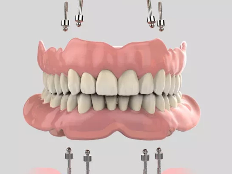 Cosmetic Dentistry Miami, Miami Teeth Whitening, Dental Veneers Miami FL, Best Cosmetic Dentist Miami, True Dentistry Plus Services, Dental Implants Miami, Permanent Tooth Replacement Miami, True Dentistry Plus Dental Implants, Best Implant Dentist in Miami, Miami Dental Implant Services, Dentures Miami, Custom Dentures Miami FL, Full Dentures Miami, Partial Dentures Miami, True Dentistry Plus Dentures, Gum Contouring Miami, Miami Gum Reshaping, Cosmetic Gum Surgery Miami FL, True Dentistry Plus Gum Contouring, Smile Enhancement Miami, Porcelain Crowns Miami, Durable Dental Crowns Miami FL, True Dentistry Plus Crowns, Cosmetic Dental Crowns Miami, Natural-Looking Crowns Miami, Smile Makeover Miami, True Dentistry Plus Smile Enhancement, Miami Smile Design, Full Smile Restoration Miami, Professional Teeth Bleaching Miami, True Dentistry Plus Whitening Services, Miami Cosmetic Teeth Whitening, Best Teeth Whitening Miami FL, Porcelain Veneers Miami FL, True Dentistry Plus Veneers, Cosmetic Veneers Miami, Best Veneers Dentist in Miami, Emergency Dentist Miami, 24/7 Dental Care Miami FL, Urgent Dental Care Miami, True Dentistry Plus Emergency Services, Miami Emergency Dental Services, Miami Dentist, Dental Care Miami FL, Family Dentistry Miami, Dental Health Blog Miami, True Dentistry Plus Blog, Miami Dental Care Tips, Dental News Miami FL, Oral Health Insights Miami, Contact True Dentistry Plus, Miami Dentist Contact, Schedule Dental Appointment Miami, Dental Office Location Miami, True Dentistry Plus Phone Number, Dental Deals Miami, True Dentistry Plus Specials, Miami Dental Offers, Teeth Whitening Discounts Miami, Invisalign Promotion Miami, Oral Surgery Miami, Wisdom Tooth Extraction Miami FL, True Dentistry Plus Oral Surgeons, Miami Oral Surgery Clinic, Tooth Extractions Miami, Bone Grafting Miami FL, Dental Surgery Miami, True Dentistry Plus Extractions, Miami Bone Graft Procedures, LANAP Miami, Laser Gum Therapy Miami FL, Minimally Invasive Gum Treatment Miami, True Dentistry Plus LANAP, Gum Disease Treatment Miami, Sinus Lift Surgery Miami, Dental Implant Preparation Miami, True Dentistry Plus Sinus Lift, Sinus Augmentation Miami, Wisdom Tooth Extractions Miami, Remove Wisdom Teeth Miami FL, Oral Surgery for Wisdom Teeth Miami, Miami Wisdom Teeth Removal, Orthodontics Miami, Braces Miami FL, Invisalign Miami, True Dentistry Plus Orthodontics, Teeth Straightening Miami, Clear Aligners Miami FL, True Dentistry Plus Invisalign, Invisalign Dentist Miami, Invisible Braces Miami, Preventive Dentistry Miami, Dental Cleanings Miami FL, Oral Exams Miami, True Dentistry Plus Preventive Care, Miami Dental Checkups, Comprehensive Dental Exams Miami, Full Oral Exam Miami FL, Dental Checkup Miami, True Dentistry Plus Exams, Dental Hygiene Miami, Teeth Cleaning Miami FL, Oral Hygiene Services Miami, True Dentistry Plus Dental Cleanings, Preventive Dental Care Miami, Nightguards Miami, Custom Mouthguards Miami FL, Teeth Grinding Protection Miami, Bruxism Treatment Miami, True Dentistry Plus Nightguards, Oral Cancer Screening Miami, Early Detection Oral Cancer Miami FL, Oral Health Screening Miami, True Dentistry Plus Screenings, Periodontics Miami, Deep Cleaning Dentist Miami, True Dentistry Plus Periodontics, Scaling and Root Planing Miami, Sleep Apnea Therapy Miami, Snoring Treatment Miami FL, Sleep Apnea Dentist Miami, Oral Appliance Therapy Miami, True Dentistry Plus Sleep Solutions, TMJ Treatment Miami, TMD Therapy Miami FL, Jaw Pain Relief Miami, True Dentistry Plus TMJ Specialist, TMJ Dentist Miami, Restorative Dentistry Miami, Dental Crowns and Bridges Miami FL, Tooth Repair Miami, True Dentistry Plus Restorations, Dental Bridges Miami, Replace Missing Teeth Miami FL, Tooth Bridge Miami, True Dentistry Plus Dental Bridges, Fixed Dental Bridge Miami, Dental Fillings Miami, Cavity Treatment Miami FL, Tooth Fillings Miami, Composite Fillings Miami, True Dentistry Plus Fillings, Smile Restoration Miami FL, Complete Dental Makeover Miami, True Dentistry Plus Reconstruction, Rebuild Smile Miami, Full-Arch Dental Implants Miami, All-on-4 Implants Miami FL, Full Mouth Implants Miami, True Dentistry Plus Implants, Root Canal Miami, Endodontic Treatment Miami FL, Tooth Pain Relief Miami, True Dentistry Plus Root Canal, Save Infected Tooth Miami