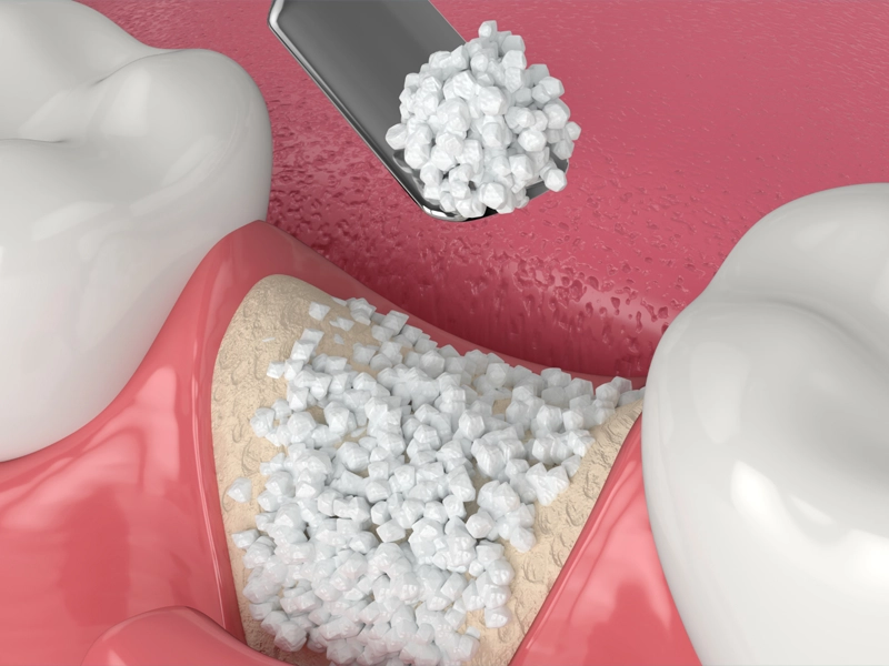 Cosmetic Dentistry Miami, Miami Teeth Whitening, Dental Veneers Miami FL, Best Cosmetic Dentist Miami, True Dentistry Plus Services, Dental Implants Miami, Permanent Tooth Replacement Miami, True Dentistry Plus Dental Implants, Best Implant Dentist in Miami, Miami Dental Implant Services, Dentures Miami, Custom Dentures Miami FL, Full Dentures Miami, Partial Dentures Miami, True Dentistry Plus Dentures, Gum Contouring Miami, Miami Gum Reshaping, Cosmetic Gum Surgery Miami FL, True Dentistry Plus Gum Contouring, Smile Enhancement Miami, Porcelain Crowns Miami, Durable Dental Crowns Miami FL, True Dentistry Plus Crowns, Cosmetic Dental Crowns Miami, Natural-Looking Crowns Miami, Smile Makeover Miami, True Dentistry Plus Smile Enhancement, Miami Smile Design, Full Smile Restoration Miami, Professional Teeth Bleaching Miami, True Dentistry Plus Whitening Services, Miami Cosmetic Teeth Whitening, Best Teeth Whitening Miami FL, Porcelain Veneers Miami FL, True Dentistry Plus Veneers, Cosmetic Veneers Miami, Best Veneers Dentist in Miami, Emergency Dentist Miami, 24/7 Dental Care Miami FL, Urgent Dental Care Miami, True Dentistry Plus Emergency Services, Miami Emergency Dental Services, Miami Dentist, Dental Care Miami FL, Family Dentistry Miami, Dental Health Blog Miami, True Dentistry Plus Blog, Miami Dental Care Tips, Dental News Miami FL, Oral Health Insights Miami, Contact True Dentistry Plus, Miami Dentist Contact, Schedule Dental Appointment Miami, Dental Office Location Miami, True Dentistry Plus Phone Number, Dental Deals Miami, True Dentistry Plus Specials, Miami Dental Offers, Teeth Whitening Discounts Miami, Invisalign Promotion Miami, Oral Surgery Miami, Wisdom Tooth Extraction Miami FL, True Dentistry Plus Oral Surgeons, Miami Oral Surgery Clinic, Tooth Extractions Miami, Bone Grafting Miami FL, Dental Surgery Miami, True Dentistry Plus Extractions, Miami Bone Graft Procedures, LANAP Miami, Laser Gum Therapy Miami FL, Minimally Invasive Gum Treatment Miami, True Dentistry Plus LANAP, Gum Disease Treatment Miami, Sinus Lift Surgery Miami, Dental Implant Preparation Miami, True Dentistry Plus Sinus Lift, Sinus Augmentation Miami, Wisdom Tooth Extractions Miami, Remove Wisdom Teeth Miami FL, Oral Surgery for Wisdom Teeth Miami, Miami Wisdom Teeth Removal, Orthodontics Miami, Braces Miami FL, Invisalign Miami, True Dentistry Plus Orthodontics, Teeth Straightening Miami, Clear Aligners Miami FL, True Dentistry Plus Invisalign, Invisalign Dentist Miami, Invisible Braces Miami, Preventive Dentistry Miami, Dental Cleanings Miami FL, Oral Exams Miami, True Dentistry Plus Preventive Care, Miami Dental Checkups, Comprehensive Dental Exams Miami, Full Oral Exam Miami FL, Dental Checkup Miami, True Dentistry Plus Exams, Dental Hygiene Miami, Teeth Cleaning Miami FL, Oral Hygiene Services Miami, True Dentistry Plus Dental Cleanings, Preventive Dental Care Miami, Nightguards Miami, Custom Mouthguards Miami FL, Teeth Grinding Protection Miami, Bruxism Treatment Miami, True Dentistry Plus Nightguards, Oral Cancer Screening Miami, Early Detection Oral Cancer Miami FL, Oral Health Screening Miami, True Dentistry Plus Screenings, Periodontics Miami, Deep Cleaning Dentist Miami, True Dentistry Plus Periodontics, Scaling and Root Planing Miami, Sleep Apnea Therapy Miami, Snoring Treatment Miami FL, Sleep Apnea Dentist Miami, Oral Appliance Therapy Miami, True Dentistry Plus Sleep Solutions, TMJ Treatment Miami, TMD Therapy Miami FL, Jaw Pain Relief Miami, True Dentistry Plus TMJ Specialist, TMJ Dentist Miami, Restorative Dentistry Miami, Dental Crowns and Bridges Miami FL, Tooth Repair Miami, True Dentistry Plus Restorations, Dental Bridges Miami, Replace Missing Teeth Miami FL, Tooth Bridge Miami, True Dentistry Plus Dental Bridges, Fixed Dental Bridge Miami, Dental Fillings Miami, Cavity Treatment Miami FL, Tooth Fillings Miami, Composite Fillings Miami, True Dentistry Plus Fillings, Smile Restoration Miami FL, Complete Dental Makeover Miami, True Dentistry Plus Reconstruction, Rebuild Smile Miami, Full-Arch Dental Implants Miami, All-on-4 Implants Miami FL, Full Mouth Implants Miami, True Dentistry Plus Implants, Root Canal Miami, Endodontic Treatment Miami FL, Tooth Pain Relief Miami, True Dentistry Plus Root Canal, Save Infected Tooth Miami