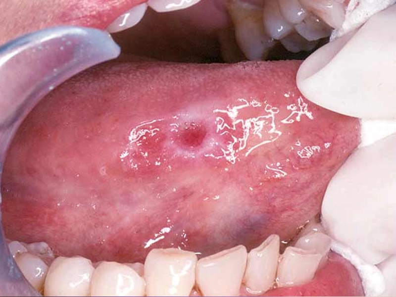 Cosmetic Dentistry Miami, Miami Teeth Whitening, Dental Veneers Miami FL, Best Cosmetic Dentist Miami, True Dentistry Plus Services, Dental Implants Miami, Permanent Tooth Replacement Miami, True Dentistry Plus Dental Implants, Best Implant Dentist in Miami, Miami Dental Implant Services, Dentures Miami, Custom Dentures Miami FL, Full Dentures Miami, Partial Dentures Miami, True Dentistry Plus Dentures, Gum Contouring Miami, Miami Gum Reshaping, Cosmetic Gum Surgery Miami FL, True Dentistry Plus Gum Contouring, Smile Enhancement Miami, Porcelain Crowns Miami, Durable Dental Crowns Miami FL, True Dentistry Plus Crowns, Cosmetic Dental Crowns Miami, Natural-Looking Crowns Miami, Smile Makeover Miami, True Dentistry Plus Smile Enhancement, Miami Smile Design, Full Smile Restoration Miami, Professional Teeth Bleaching Miami, True Dentistry Plus Whitening Services, Miami Cosmetic Teeth Whitening, Best Teeth Whitening Miami FL, Porcelain Veneers Miami FL, True Dentistry Plus Veneers, Cosmetic Veneers Miami, Best Veneers Dentist in Miami, Emergency Dentist Miami, 24/7 Dental Care Miami FL, Urgent Dental Care Miami, True Dentistry Plus Emergency Services, Miami Emergency Dental Services, Miami Dentist, Dental Care Miami FL, Family Dentistry Miami, Dental Health Blog Miami, True Dentistry Plus Blog, Miami Dental Care Tips, Dental News Miami FL, Oral Health Insights Miami, Contact True Dentistry Plus, Miami Dentist Contact, Schedule Dental Appointment Miami, Dental Office Location Miami, True Dentistry Plus Phone Number, Dental Deals Miami, True Dentistry Plus Specials, Miami Dental Offers, Teeth Whitening Discounts Miami, Invisalign Promotion Miami, Oral Surgery Miami, Wisdom Tooth Extraction Miami FL, True Dentistry Plus Oral Surgeons, Miami Oral Surgery Clinic, Tooth Extractions Miami, Bone Grafting Miami FL, Dental Surgery Miami, True Dentistry Plus Extractions, Miami Bone Graft Procedures, LANAP Miami, Laser Gum Therapy Miami FL, Minimally Invasive Gum Treatment Miami, True Dentistry Plus LANAP, Gum Disease Treatment Miami, Sinus Lift Surgery Miami, Dental Implant Preparation Miami, True Dentistry Plus Sinus Lift, Sinus Augmentation Miami, Wisdom Tooth Extractions Miami, Remove Wisdom Teeth Miami FL, Oral Surgery for Wisdom Teeth Miami, Miami Wisdom Teeth Removal, Orthodontics Miami, Braces Miami FL, Invisalign Miami, True Dentistry Plus Orthodontics, Teeth Straightening Miami, Clear Aligners Miami FL, True Dentistry Plus Invisalign, Invisalign Dentist Miami, Invisible Braces Miami, Preventive Dentistry Miami, Dental Cleanings Miami FL, Oral Exams Miami, True Dentistry Plus Preventive Care, Miami Dental Checkups, Comprehensive Dental Exams Miami, Full Oral Exam Miami FL, Dental Checkup Miami, True Dentistry Plus Exams, Dental Hygiene Miami, Teeth Cleaning Miami FL, Oral Hygiene Services Miami, True Dentistry Plus Dental Cleanings, Preventive Dental Care Miami, Nightguards Miami, Custom Mouthguards Miami FL, Teeth Grinding Protection Miami, Bruxism Treatment Miami, True Dentistry Plus Nightguards, Oral Cancer Screening Miami, Early Detection Oral Cancer Miami FL, Oral Health Screening Miami, True Dentistry Plus Screenings, Periodontics Miami, Deep Cleaning Dentist Miami, True Dentistry Plus Periodontics, Scaling and Root Planing Miami, Sleep Apnea Therapy Miami, Snoring Treatment Miami FL, Sleep Apnea Dentist Miami, Oral Appliance Therapy Miami, True Dentistry Plus Sleep Solutions, TMJ Treatment Miami, TMD Therapy Miami FL, Jaw Pain Relief Miami, True Dentistry Plus TMJ Specialist, TMJ Dentist Miami, Restorative Dentistry Miami, Dental Crowns and Bridges Miami FL, Tooth Repair Miami, True Dentistry Plus Restorations, Dental Bridges Miami, Replace Missing Teeth Miami FL, Tooth Bridge Miami, True Dentistry Plus Dental Bridges, Fixed Dental Bridge Miami, Dental Fillings Miami, Cavity Treatment Miami FL, Tooth Fillings Miami, Composite Fillings Miami, True Dentistry Plus Fillings, Smile Restoration Miami FL, Complete Dental Makeover Miami, True Dentistry Plus Reconstruction, Rebuild Smile Miami, Full-Arch Dental Implants Miami, All-on-4 Implants Miami FL, Full Mouth Implants Miami, True Dentistry Plus Implants, Root Canal Miami, Endodontic Treatment Miami FL, Tooth Pain Relief Miami, True Dentistry Plus Root Canal, Save Infected Tooth Miami