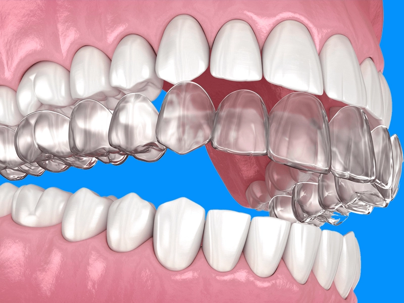 Cosmetic Dentistry Miami, Miami Teeth Whitening, Dental Veneers Miami FL, Best Cosmetic Dentist Miami, True Dentistry Plus Services, Dental Implants Miami, Permanent Tooth Replacement Miami, True Dentistry Plus Dental Implants, Best Implant Dentist in Miami, Miami Dental Implant Services, Dentures Miami, Custom Dentures Miami FL, Full Dentures Miami, Partial Dentures Miami, True Dentistry Plus Dentures, Gum Contouring Miami, Miami Gum Reshaping, Cosmetic Gum Surgery Miami FL, True Dentistry Plus Gum Contouring, Smile Enhancement Miami, Porcelain Crowns Miami, Durable Dental Crowns Miami FL, True Dentistry Plus Crowns, Cosmetic Dental Crowns Miami, Natural-Looking Crowns Miami, Smile Makeover Miami, True Dentistry Plus Smile Enhancement, Miami Smile Design, Full Smile Restoration Miami, Professional Teeth Bleaching Miami, True Dentistry Plus Whitening Services, Miami Cosmetic Teeth Whitening, Best Teeth Whitening Miami FL, Porcelain Veneers Miami FL, True Dentistry Plus Veneers, Cosmetic Veneers Miami, Best Veneers Dentist in Miami, Emergency Dentist Miami, 24/7 Dental Care Miami FL, Urgent Dental Care Miami, True Dentistry Plus Emergency Services, Miami Emergency Dental Services, Miami Dentist, Dental Care Miami FL, Family Dentistry Miami, Dental Health Blog Miami, True Dentistry Plus Blog, Miami Dental Care Tips, Dental News Miami FL, Oral Health Insights Miami, Contact True Dentistry Plus, Miami Dentist Contact, Schedule Dental Appointment Miami, Dental Office Location Miami, True Dentistry Plus Phone Number, Dental Deals Miami, True Dentistry Plus Specials, Miami Dental Offers, Teeth Whitening Discounts Miami, Invisalign Promotion Miami, Oral Surgery Miami, Wisdom Tooth Extraction Miami FL, True Dentistry Plus Oral Surgeons, Miami Oral Surgery Clinic, Tooth Extractions Miami, Bone Grafting Miami FL, Dental Surgery Miami, True Dentistry Plus Extractions, Miami Bone Graft Procedures, LANAP Miami, Laser Gum Therapy Miami FL, Minimally Invasive Gum Treatment Miami, True Dentistry Plus LANAP, Gum Disease Treatment Miami, Sinus Lift Surgery Miami, Dental Implant Preparation Miami, True Dentistry Plus Sinus Lift, Sinus Augmentation Miami, Wisdom Tooth Extractions Miami, Remove Wisdom Teeth Miami FL, Oral Surgery for Wisdom Teeth Miami, Miami Wisdom Teeth Removal, Orthodontics Miami, Braces Miami FL, Invisalign Miami, True Dentistry Plus Orthodontics, Teeth Straightening Miami, Clear Aligners Miami FL, True Dentistry Plus Invisalign, Invisalign Dentist Miami, Invisible Braces Miami, Preventive Dentistry Miami, Dental Cleanings Miami FL, Oral Exams Miami, True Dentistry Plus Preventive Care, Miami Dental Checkups, Comprehensive Dental Exams Miami, Full Oral Exam Miami FL, Dental Checkup Miami, True Dentistry Plus Exams, Dental Hygiene Miami, Teeth Cleaning Miami FL, Oral Hygiene Services Miami, True Dentistry Plus Dental Cleanings, Preventive Dental Care Miami, Nightguards Miami, Custom Mouthguards Miami FL, Teeth Grinding Protection Miami, Bruxism Treatment Miami, True Dentistry Plus Nightguards, Oral Cancer Screening Miami, Early Detection Oral Cancer Miami FL, Oral Health Screening Miami, True Dentistry Plus Screenings, Periodontics Miami, Deep Cleaning Dentist Miami, True Dentistry Plus Periodontics, Scaling and Root Planing Miami, Sleep Apnea Therapy Miami, Snoring Treatment Miami FL, Sleep Apnea Dentist Miami, Oral Appliance Therapy Miami, True Dentistry Plus Sleep Solutions, TMJ Treatment Miami, TMD Therapy Miami FL, Jaw Pain Relief Miami, True Dentistry Plus TMJ Specialist, TMJ Dentist Miami, Restorative Dentistry Miami, Dental Crowns and Bridges Miami FL, Tooth Repair Miami, True Dentistry Plus Restorations, Dental Bridges Miami, Replace Missing Teeth Miami FL, Tooth Bridge Miami, True Dentistry Plus Dental Bridges, Fixed Dental Bridge Miami, Dental Fillings Miami, Cavity Treatment Miami FL, Tooth Fillings Miami, Composite Fillings Miami, True Dentistry Plus Fillings, Smile Restoration Miami FL, Complete Dental Makeover Miami, True Dentistry Plus Reconstruction, Rebuild Smile Miami, Full-Arch Dental Implants Miami, All-on-4 Implants Miami FL, Full Mouth Implants Miami, True Dentistry Plus Implants, Root Canal Miami, Endodontic Treatment Miami FL, Tooth Pain Relief Miami, True Dentistry Plus Root Canal, Save Infected Tooth Miami