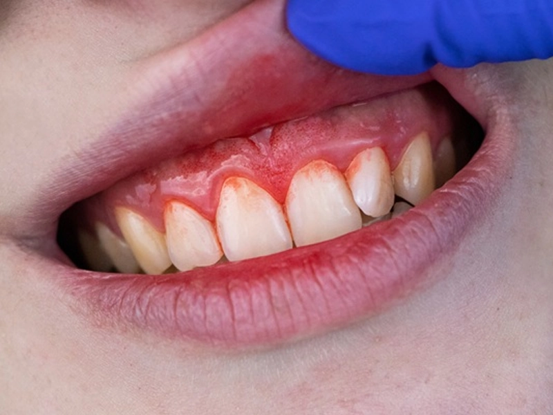 Cosmetic Dentistry Miami, Miami Teeth Whitening, Dental Veneers Miami FL, Best Cosmetic Dentist Miami, True Dentistry Plus Services, Dental Implants Miami, Permanent Tooth Replacement Miami, True Dentistry Plus Dental Implants, Best Implant Dentist in Miami, Miami Dental Implant Services, Dentures Miami, Custom Dentures Miami FL, Full Dentures Miami, Partial Dentures Miami, True Dentistry Plus Dentures, Gum Contouring Miami, Miami Gum Reshaping, Cosmetic Gum Surgery Miami FL, True Dentistry Plus Gum Contouring, Smile Enhancement Miami, Porcelain Crowns Miami, Durable Dental Crowns Miami FL, True Dentistry Plus Crowns, Cosmetic Dental Crowns Miami, Natural-Looking Crowns Miami, Smile Makeover Miami, True Dentistry Plus Smile Enhancement, Miami Smile Design, Full Smile Restoration Miami, Professional Teeth Bleaching Miami, True Dentistry Plus Whitening Services, Miami Cosmetic Teeth Whitening, Best Teeth Whitening Miami FL, Porcelain Veneers Miami FL, True Dentistry Plus Veneers, Cosmetic Veneers Miami, Best Veneers Dentist in Miami, Emergency Dentist Miami, 24/7 Dental Care Miami FL, Urgent Dental Care Miami, True Dentistry Plus Emergency Services, Miami Emergency Dental Services, Miami Dentist, Dental Care Miami FL, Family Dentistry Miami, Dental Health Blog Miami, True Dentistry Plus Blog, Miami Dental Care Tips, Dental News Miami FL, Oral Health Insights Miami, Contact True Dentistry Plus, Miami Dentist Contact, Schedule Dental Appointment Miami, Dental Office Location Miami, True Dentistry Plus Phone Number, Dental Deals Miami, True Dentistry Plus Specials, Miami Dental Offers, Teeth Whitening Discounts Miami, Invisalign Promotion Miami, Oral Surgery Miami, Wisdom Tooth Extraction Miami FL, True Dentistry Plus Oral Surgeons, Miami Oral Surgery Clinic, Tooth Extractions Miami, Bone Grafting Miami FL, Dental Surgery Miami, True Dentistry Plus Extractions, Miami Bone Graft Procedures, LANAP Miami, Laser Gum Therapy Miami FL, Minimally Invasive Gum Treatment Miami, True Dentistry Plus LANAP, Gum Disease Treatment Miami, Sinus Lift Surgery Miami, Dental Implant Preparation Miami, True Dentistry Plus Sinus Lift, Sinus Augmentation Miami, Wisdom Tooth Extractions Miami, Remove Wisdom Teeth Miami FL, Oral Surgery for Wisdom Teeth Miami, Miami Wisdom Teeth Removal, Orthodontics Miami, Braces Miami FL, Invisalign Miami, True Dentistry Plus Orthodontics, Teeth Straightening Miami, Clear Aligners Miami FL, True Dentistry Plus Invisalign, Invisalign Dentist Miami, Invisible Braces Miami, Preventive Dentistry Miami, Dental Cleanings Miami FL, Oral Exams Miami, True Dentistry Plus Preventive Care, Miami Dental Checkups, Comprehensive Dental Exams Miami, Full Oral Exam Miami FL, Dental Checkup Miami, True Dentistry Plus Exams, Dental Hygiene Miami, Teeth Cleaning Miami FL, Oral Hygiene Services Miami, True Dentistry Plus Dental Cleanings, Preventive Dental Care Miami, Nightguards Miami, Custom Mouthguards Miami FL, Teeth Grinding Protection Miami, Bruxism Treatment Miami, True Dentistry Plus Nightguards, Oral Cancer Screening Miami, Early Detection Oral Cancer Miami FL, Oral Health Screening Miami, True Dentistry Plus Screenings, Periodontics Miami, Deep Cleaning Dentist Miami, True Dentistry Plus Periodontics, Scaling and Root Planing Miami, Sleep Apnea Therapy Miami, Snoring Treatment Miami FL, Sleep Apnea Dentist Miami, Oral Appliance Therapy Miami, True Dentistry Plus Sleep Solutions, TMJ Treatment Miami, TMD Therapy Miami FL, Jaw Pain Relief Miami, True Dentistry Plus TMJ Specialist, TMJ Dentist Miami, Restorative Dentistry Miami, Dental Crowns and Bridges Miami FL, Tooth Repair Miami, True Dentistry Plus Restorations, Dental Bridges Miami, Replace Missing Teeth Miami FL, Tooth Bridge Miami, True Dentistry Plus Dental Bridges, Fixed Dental Bridge Miami, Dental Fillings Miami, Cavity Treatment Miami FL, Tooth Fillings Miami, Composite Fillings Miami, True Dentistry Plus Fillings, Smile Restoration Miami FL, Complete Dental Makeover Miami, True Dentistry Plus Reconstruction, Rebuild Smile Miami, Full-Arch Dental Implants Miami, All-on-4 Implants Miami FL, Full Mouth Implants Miami, True Dentistry Plus Implants, Root Canal Miami, Endodontic Treatment Miami FL, Tooth Pain Relief Miami, True Dentistry Plus Root Canal, Save Infected Tooth Miami