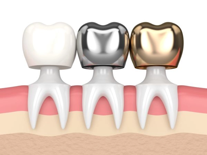 Cosmetic Dentistry Miami, Miami Teeth Whitening, Dental Veneers Miami FL, Best Cosmetic Dentist Miami, True Dentistry Plus Services, Dental Implants Miami, Permanent Tooth Replacement Miami, True Dentistry Plus Dental Implants, Best Implant Dentist in Miami, Miami Dental Implant Services, Dentures Miami, Custom Dentures Miami FL, Full Dentures Miami, Partial Dentures Miami, True Dentistry Plus Dentures, Gum Contouring Miami, Miami Gum Reshaping, Cosmetic Gum Surgery Miami FL, True Dentistry Plus Gum Contouring, Smile Enhancement Miami, Porcelain Crowns Miami, Durable Dental Crowns Miami FL, True Dentistry Plus Crowns, Cosmetic Dental Crowns Miami, Natural-Looking Crowns Miami, Smile Makeover Miami, True Dentistry Plus Smile Enhancement, Miami Smile Design, Full Smile Restoration Miami, Professional Teeth Bleaching Miami, True Dentistry Plus Whitening Services, Miami Cosmetic Teeth Whitening, Best Teeth Whitening Miami FL, Porcelain Veneers Miami FL, True Dentistry Plus Veneers, Cosmetic Veneers Miami, Best Veneers Dentist in Miami, Emergency Dentist Miami, 24/7 Dental Care Miami FL, Urgent Dental Care Miami, True Dentistry Plus Emergency Services, Miami Emergency Dental Services, Miami Dentist, Dental Care Miami FL, Family Dentistry Miami, Dental Health Blog Miami, True Dentistry Plus Blog, Miami Dental Care Tips, Dental News Miami FL, Oral Health Insights Miami, Contact True Dentistry Plus, Miami Dentist Contact, Schedule Dental Appointment Miami, Dental Office Location Miami, True Dentistry Plus Phone Number, Dental Deals Miami, True Dentistry Plus Specials, Miami Dental Offers, Teeth Whitening Discounts Miami, Invisalign Promotion Miami, Oral Surgery Miami, Wisdom Tooth Extraction Miami FL, True Dentistry Plus Oral Surgeons, Miami Oral Surgery Clinic, Tooth Extractions Miami, Bone Grafting Miami FL, Dental Surgery Miami, True Dentistry Plus Extractions, Miami Bone Graft Procedures, LANAP Miami, Laser Gum Therapy Miami FL, Minimally Invasive Gum Treatment Miami, True Dentistry Plus LANAP, Gum Disease Treatment Miami, Sinus Lift Surgery Miami, Dental Implant Preparation Miami, True Dentistry Plus Sinus Lift, Sinus Augmentation Miami, Wisdom Tooth Extractions Miami, Remove Wisdom Teeth Miami FL, Oral Surgery for Wisdom Teeth Miami, Miami Wisdom Teeth Removal, Orthodontics Miami, Braces Miami FL, Invisalign Miami, True Dentistry Plus Orthodontics, Teeth Straightening Miami, Clear Aligners Miami FL, True Dentistry Plus Invisalign, Invisalign Dentist Miami, Invisible Braces Miami, Preventive Dentistry Miami, Dental Cleanings Miami FL, Oral Exams Miami, True Dentistry Plus Preventive Care, Miami Dental Checkups, Comprehensive Dental Exams Miami, Full Oral Exam Miami FL, Dental Checkup Miami, True Dentistry Plus Exams, Dental Hygiene Miami, Teeth Cleaning Miami FL, Oral Hygiene Services Miami, True Dentistry Plus Dental Cleanings, Preventive Dental Care Miami, Nightguards Miami, Custom Mouthguards Miami FL, Teeth Grinding Protection Miami, Bruxism Treatment Miami, True Dentistry Plus Nightguards, Oral Cancer Screening Miami, Early Detection Oral Cancer Miami FL, Oral Health Screening Miami, True Dentistry Plus Screenings, Periodontics Miami, Deep Cleaning Dentist Miami, True Dentistry Plus Periodontics, Scaling and Root Planing Miami, Sleep Apnea Therapy Miami, Snoring Treatment Miami FL, Sleep Apnea Dentist Miami, Oral Appliance Therapy Miami, True Dentistry Plus Sleep Solutions, TMJ Treatment Miami, TMD Therapy Miami FL, Jaw Pain Relief Miami, True Dentistry Plus TMJ Specialist, TMJ Dentist Miami, Restorative Dentistry Miami, Dental Crowns and Bridges Miami FL, Tooth Repair Miami, True Dentistry Plus Restorations, Dental Bridges Miami, Replace Missing Teeth Miami FL, Tooth Bridge Miami, True Dentistry Plus Dental Bridges, Fixed Dental Bridge Miami, Dental Fillings Miami, Cavity Treatment Miami FL, Tooth Fillings Miami, Composite Fillings Miami, True Dentistry Plus Fillings, Smile Restoration Miami FL, Complete Dental Makeover Miami, True Dentistry Plus Reconstruction, Rebuild Smile Miami, Full-Arch Dental Implants Miami, All-on-4 Implants Miami FL, Full Mouth Implants Miami, True Dentistry Plus Implants, Root Canal Miami, Endodontic Treatment Miami FL, Tooth Pain Relief Miami, True Dentistry Plus Root Canal, Save Infected Tooth Miami