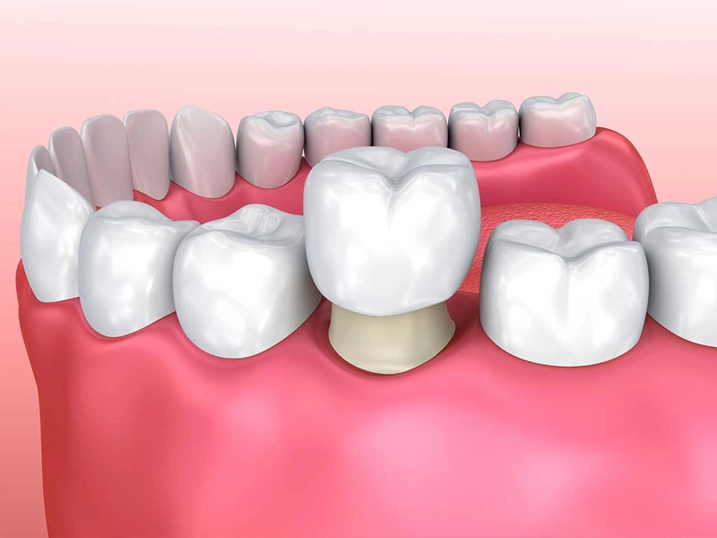 Cosmetic Dentistry Miami, Miami Teeth Whitening, Dental Veneers Miami FL, Best Cosmetic Dentist Miami, True Dentistry Plus Services, Dental Implants Miami, Permanent Tooth Replacement Miami, True Dentistry Plus Dental Implants, Best Implant Dentist in Miami, Miami Dental Implant Services, Dentures Miami, Custom Dentures Miami FL, Full Dentures Miami, Partial Dentures Miami, True Dentistry Plus Dentures, Gum Contouring Miami, Miami Gum Reshaping, Cosmetic Gum Surgery Miami FL, True Dentistry Plus Gum Contouring, Smile Enhancement Miami, Porcelain Crowns Miami, Durable Dental Crowns Miami FL, True Dentistry Plus Crowns, Cosmetic Dental Crowns Miami, Natural-Looking Crowns Miami, Smile Makeover Miami, True Dentistry Plus Smile Enhancement, Miami Smile Design, Full Smile Restoration Miami, Professional Teeth Bleaching Miami, True Dentistry Plus Whitening Services, Miami Cosmetic Teeth Whitening, Best Teeth Whitening Miami FL, Porcelain Veneers Miami FL, True Dentistry Plus Veneers, Cosmetic Veneers Miami, Best Veneers Dentist in Miami, Emergency Dentist Miami, 24/7 Dental Care Miami FL, Urgent Dental Care Miami, True Dentistry Plus Emergency Services, Miami Emergency Dental Services, Miami Dentist, Dental Care Miami FL, Family Dentistry Miami, Dental Health Blog Miami, True Dentistry Plus Blog, Miami Dental Care Tips, Dental News Miami FL, Oral Health Insights Miami, Contact True Dentistry Plus, Miami Dentist Contact, Schedule Dental Appointment Miami, Dental Office Location Miami, True Dentistry Plus Phone Number, Dental Deals Miami, True Dentistry Plus Specials, Miami Dental Offers, Teeth Whitening Discounts Miami, Invisalign Promotion Miami, Oral Surgery Miami, Wisdom Tooth Extraction Miami FL, True Dentistry Plus Oral Surgeons, Miami Oral Surgery Clinic, Tooth Extractions Miami, Bone Grafting Miami FL, Dental Surgery Miami, True Dentistry Plus Extractions, Miami Bone Graft Procedures, LANAP Miami, Laser Gum Therapy Miami FL, Minimally Invasive Gum Treatment Miami, True Dentistry Plus LANAP, Gum Disease Treatment Miami, Sinus Lift Surgery Miami, Dental Implant Preparation Miami, True Dentistry Plus Sinus Lift, Sinus Augmentation Miami, Wisdom Tooth Extractions Miami, Remove Wisdom Teeth Miami FL, Oral Surgery for Wisdom Teeth Miami, Miami Wisdom Teeth Removal, Orthodontics Miami, Braces Miami FL, Invisalign Miami, True Dentistry Plus Orthodontics, Teeth Straightening Miami, Clear Aligners Miami FL, True Dentistry Plus Invisalign, Invisalign Dentist Miami, Invisible Braces Miami, Preventive Dentistry Miami, Dental Cleanings Miami FL, Oral Exams Miami, True Dentistry Plus Preventive Care, Miami Dental Checkups, Comprehensive Dental Exams Miami, Full Oral Exam Miami FL, Dental Checkup Miami, True Dentistry Plus Exams, Dental Hygiene Miami, Teeth Cleaning Miami FL, Oral Hygiene Services Miami, True Dentistry Plus Dental Cleanings, Preventive Dental Care Miami, Nightguards Miami, Custom Mouthguards Miami FL, Teeth Grinding Protection Miami, Bruxism Treatment Miami, True Dentistry Plus Nightguards, Oral Cancer Screening Miami, Early Detection Oral Cancer Miami FL, Oral Health Screening Miami, True Dentistry Plus Screenings, Periodontics Miami, Deep Cleaning Dentist Miami, True Dentistry Plus Periodontics, Scaling and Root Planing Miami, Sleep Apnea Therapy Miami, Snoring Treatment Miami FL, Sleep Apnea Dentist Miami, Oral Appliance Therapy Miami, True Dentistry Plus Sleep Solutions, TMJ Treatment Miami, TMD Therapy Miami FL, Jaw Pain Relief Miami, True Dentistry Plus TMJ Specialist, TMJ Dentist Miami, Restorative Dentistry Miami, Dental Crowns and Bridges Miami FL, Tooth Repair Miami, True Dentistry Plus Restorations, Dental Bridges Miami, Replace Missing Teeth Miami FL, Tooth Bridge Miami, True Dentistry Plus Dental Bridges, Fixed Dental Bridge Miami, Dental Fillings Miami, Cavity Treatment Miami FL, Tooth Fillings Miami, Composite Fillings Miami, True Dentistry Plus Fillings, Smile Restoration Miami FL, Complete Dental Makeover Miami, True Dentistry Plus Reconstruction, Rebuild Smile Miami, Full-Arch Dental Implants Miami, All-on-4 Implants Miami FL, Full Mouth Implants Miami, True Dentistry Plus Implants, Root Canal Miami, Endodontic Treatment Miami FL, Tooth Pain Relief Miami, True Dentistry Plus Root Canal, Save Infected Tooth Miami