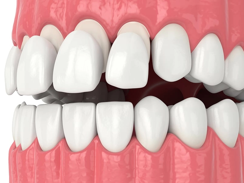 Cosmetic Dentistry Miami, Miami Teeth Whitening, Dental Veneers Miami FL, Best Cosmetic Dentist Miami, True Dentistry Plus Services, Dental Implants Miami, Permanent Tooth Replacement Miami, True Dentistry Plus Dental Implants, Best Implant Dentist in Miami, Miami Dental Implant Services, Dentures Miami, Custom Dentures Miami FL, Full Dentures Miami, Partial Dentures Miami, True Dentistry Plus Dentures, Gum Contouring Miami, Miami Gum Reshaping, Cosmetic Gum Surgery Miami FL, True Dentistry Plus Gum Contouring, Smile Enhancement Miami, Porcelain Crowns Miami, Durable Dental Crowns Miami FL, True Dentistry Plus Crowns, Cosmetic Dental Crowns Miami, Natural-Looking Crowns Miami, Smile Makeover Miami, True Dentistry Plus Smile Enhancement, Miami Smile Design, Full Smile Restoration Miami, Professional Teeth Bleaching Miami, True Dentistry Plus Whitening Services, Miami Cosmetic Teeth Whitening, Best Teeth Whitening Miami FL, Porcelain Veneers Miami FL, True Dentistry Plus Veneers, Cosmetic Veneers Miami, Best Veneers Dentist in Miami, Emergency Dentist Miami, 24/7 Dental Care Miami FL, Urgent Dental Care Miami, True Dentistry Plus Emergency Services, Miami Emergency Dental Services, Miami Dentist, Dental Care Miami FL, Family Dentistry Miami, Dental Health Blog Miami, True Dentistry Plus Blog, Miami Dental Care Tips, Dental News Miami FL, Oral Health Insights Miami, Contact True Dentistry Plus, Miami Dentist Contact, Schedule Dental Appointment Miami, Dental Office Location Miami, True Dentistry Plus Phone Number, Dental Deals Miami, True Dentistry Plus Specials, Miami Dental Offers, Teeth Whitening Discounts Miami, Invisalign Promotion Miami, Oral Surgery Miami, Wisdom Tooth Extraction Miami FL, True Dentistry Plus Oral Surgeons, Miami Oral Surgery Clinic, Tooth Extractions Miami, Bone Grafting Miami FL, Dental Surgery Miami, True Dentistry Plus Extractions, Miami Bone Graft Procedures, LANAP Miami, Laser Gum Therapy Miami FL, Minimally Invasive Gum Treatment Miami, True Dentistry Plus LANAP, Gum Disease Treatment Miami, Sinus Lift Surgery Miami, Dental Implant Preparation Miami, True Dentistry Plus Sinus Lift, Sinus Augmentation Miami, Wisdom Tooth Extractions Miami, Remove Wisdom Teeth Miami FL, Oral Surgery for Wisdom Teeth Miami, Miami Wisdom Teeth Removal, Orthodontics Miami, Braces Miami FL, Invisalign Miami, True Dentistry Plus Orthodontics, Teeth Straightening Miami, Clear Aligners Miami FL, True Dentistry Plus Invisalign, Invisalign Dentist Miami, Invisible Braces Miami, Preventive Dentistry Miami, Dental Cleanings Miami FL, Oral Exams Miami, True Dentistry Plus Preventive Care, Miami Dental Checkups, Comprehensive Dental Exams Miami, Full Oral Exam Miami FL, Dental Checkup Miami, True Dentistry Plus Exams, Dental Hygiene Miami, Teeth Cleaning Miami FL, Oral Hygiene Services Miami, True Dentistry Plus Dental Cleanings, Preventive Dental Care Miami, Nightguards Miami, Custom Mouthguards Miami FL, Teeth Grinding Protection Miami, Bruxism Treatment Miami, True Dentistry Plus Nightguards, Oral Cancer Screening Miami, Early Detection Oral Cancer Miami FL, Oral Health Screening Miami, True Dentistry Plus Screenings, Periodontics Miami, Deep Cleaning Dentist Miami, True Dentistry Plus Periodontics, Scaling and Root Planing Miami, Sleep Apnea Therapy Miami, Snoring Treatment Miami FL, Sleep Apnea Dentist Miami, Oral Appliance Therapy Miami, True Dentistry Plus Sleep Solutions, TMJ Treatment Miami, TMD Therapy Miami FL, Jaw Pain Relief Miami, True Dentistry Plus TMJ Specialist, TMJ Dentist Miami, Restorative Dentistry Miami, Dental Crowns and Bridges Miami FL, Tooth Repair Miami, True Dentistry Plus Restorations, Dental Bridges Miami, Replace Missing Teeth Miami FL, Tooth Bridge Miami, True Dentistry Plus Dental Bridges, Fixed Dental Bridge Miami, Dental Fillings Miami, Cavity Treatment Miami FL, Tooth Fillings Miami, Composite Fillings Miami, True Dentistry Plus Fillings, Smile Restoration Miami FL, Complete Dental Makeover Miami, True Dentistry Plus Reconstruction, Rebuild Smile Miami, Full-Arch Dental Implants Miami, All-on-4 Implants Miami FL, Full Mouth Implants Miami, True Dentistry Plus Implants, Root Canal Miami, Endodontic Treatment Miami FL, Tooth Pain Relief Miami, True Dentistry Plus Root Canal, Save Infected Tooth Miami