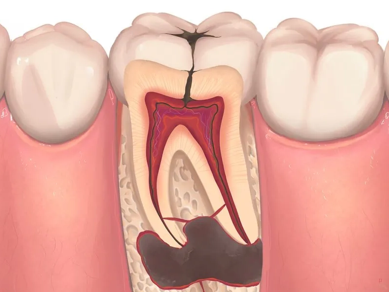 Cosmetic Dentistry Miami, Miami Teeth Whitening, Dental Veneers Miami FL, Best Cosmetic Dentist Miami, True Dentistry Plus Services, Dental Implants Miami, Permanent Tooth Replacement Miami, True Dentistry Plus Dental Implants, Best Implant Dentist in Miami, Miami Dental Implant Services, Dentures Miami, Custom Dentures Miami FL, Full Dentures Miami, Partial Dentures Miami, True Dentistry Plus Dentures, Gum Contouring Miami, Miami Gum Reshaping, Cosmetic Gum Surgery Miami FL, True Dentistry Plus Gum Contouring, Smile Enhancement Miami, Porcelain Crowns Miami, Durable Dental Crowns Miami FL, True Dentistry Plus Crowns, Cosmetic Dental Crowns Miami, Natural-Looking Crowns Miami, Smile Makeover Miami, True Dentistry Plus Smile Enhancement, Miami Smile Design, Full Smile Restoration Miami, Professional Teeth Bleaching Miami, True Dentistry Plus Whitening Services, Miami Cosmetic Teeth Whitening, Best Teeth Whitening Miami FL, Porcelain Veneers Miami FL, True Dentistry Plus Veneers, Cosmetic Veneers Miami, Best Veneers Dentist in Miami, Emergency Dentist Miami, 24/7 Dental Care Miami FL, Urgent Dental Care Miami, True Dentistry Plus Emergency Services, Miami Emergency Dental Services, Miami Dentist, Dental Care Miami FL, Family Dentistry Miami, Dental Health Blog Miami, True Dentistry Plus Blog, Miami Dental Care Tips, Dental News Miami FL, Oral Health Insights Miami, Contact True Dentistry Plus, Miami Dentist Contact, Schedule Dental Appointment Miami, Dental Office Location Miami, True Dentistry Plus Phone Number, Dental Deals Miami, True Dentistry Plus Specials, Miami Dental Offers, Teeth Whitening Discounts Miami, Invisalign Promotion Miami, Oral Surgery Miami, Wisdom Tooth Extraction Miami FL, True Dentistry Plus Oral Surgeons, Miami Oral Surgery Clinic, Tooth Extractions Miami, Bone Grafting Miami FL, Dental Surgery Miami, True Dentistry Plus Extractions, Miami Bone Graft Procedures, LANAP Miami, Laser Gum Therapy Miami FL, Minimally Invasive Gum Treatment Miami, True Dentistry Plus LANAP, Gum Disease Treatment Miami, Sinus Lift Surgery Miami, Dental Implant Preparation Miami, True Dentistry Plus Sinus Lift, Sinus Augmentation Miami, Wisdom Tooth Extractions Miami, Remove Wisdom Teeth Miami FL, Oral Surgery for Wisdom Teeth Miami, Miami Wisdom Teeth Removal, Orthodontics Miami, Braces Miami FL, Invisalign Miami, True Dentistry Plus Orthodontics, Teeth Straightening Miami, Clear Aligners Miami FL, True Dentistry Plus Invisalign, Invisalign Dentist Miami, Invisible Braces Miami, Preventive Dentistry Miami, Dental Cleanings Miami FL, Oral Exams Miami, True Dentistry Plus Preventive Care, Miami Dental Checkups, Comprehensive Dental Exams Miami, Full Oral Exam Miami FL, Dental Checkup Miami, True Dentistry Plus Exams, Dental Hygiene Miami, Teeth Cleaning Miami FL, Oral Hygiene Services Miami, True Dentistry Plus Dental Cleanings, Preventive Dental Care Miami, Nightguards Miami, Custom Mouthguards Miami FL, Teeth Grinding Protection Miami, Bruxism Treatment Miami, True Dentistry Plus Nightguards, Oral Cancer Screening Miami, Early Detection Oral Cancer Miami FL, Oral Health Screening Miami, True Dentistry Plus Screenings, Periodontics Miami, Deep Cleaning Dentist Miami, True Dentistry Plus Periodontics, Scaling and Root Planing Miami, Sleep Apnea Therapy Miami, Snoring Treatment Miami FL, Sleep Apnea Dentist Miami, Oral Appliance Therapy Miami, True Dentistry Plus Sleep Solutions, TMJ Treatment Miami, TMD Therapy Miami FL, Jaw Pain Relief Miami, True Dentistry Plus TMJ Specialist, TMJ Dentist Miami, Restorative Dentistry Miami, Dental Crowns and Bridges Miami FL, Tooth Repair Miami, True Dentistry Plus Restorations, Dental Bridges Miami, Replace Missing Teeth Miami FL, Tooth Bridge Miami, True Dentistry Plus Dental Bridges, Fixed Dental Bridge Miami, Dental Fillings Miami, Cavity Treatment Miami FL, Tooth Fillings Miami, Composite Fillings Miami, True Dentistry Plus Fillings, Smile Restoration Miami FL, Complete Dental Makeover Miami, True Dentistry Plus Reconstruction, Rebuild Smile Miami, Full-Arch Dental Implants Miami, All-on-4 Implants Miami FL, Full Mouth Implants Miami, True Dentistry Plus Implants, Root Canal Miami, Endodontic Treatment Miami FL, Tooth Pain Relief Miami, True Dentistry Plus Root Canal, Save Infected Tooth Miami