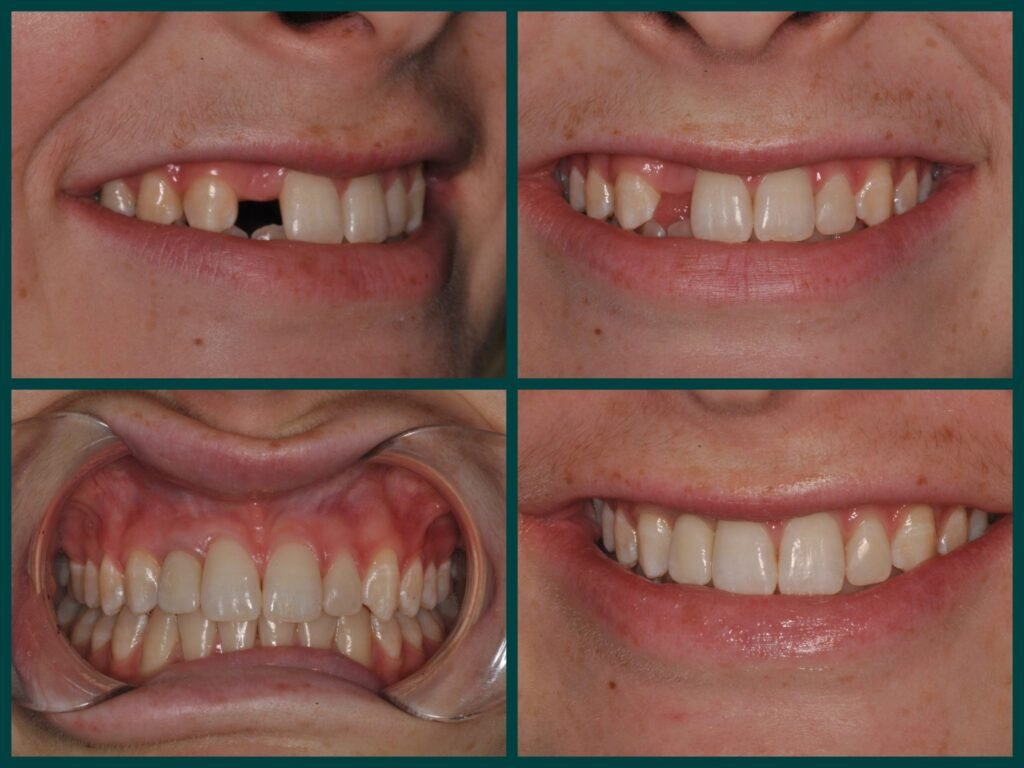 Dental Implants: A Permanent Solution for Missing Teeth