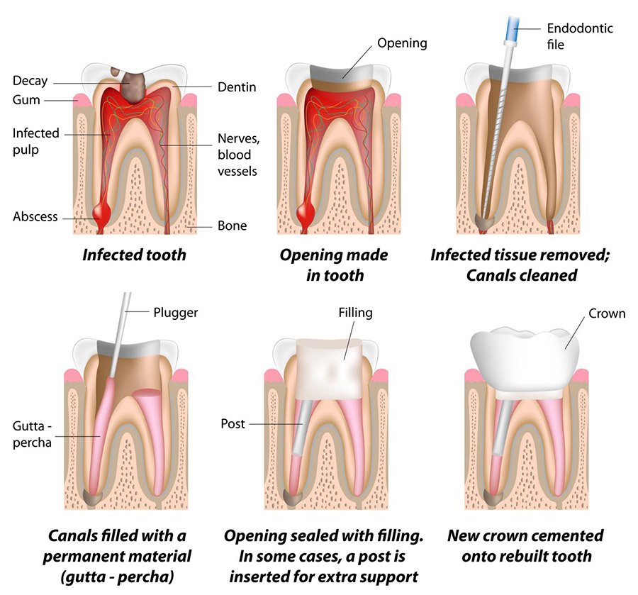Root Canal Treatment: Relieving Pain and Saving Your Natural Tooth